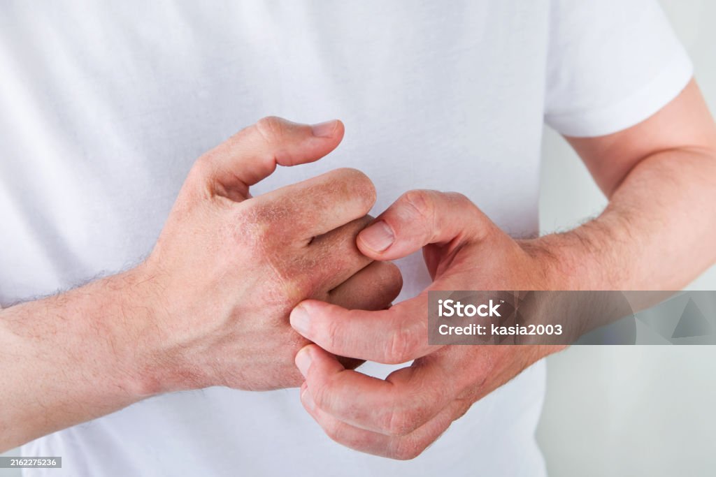 Why Minor Skin Irritation Matters More If You Have Diabetes