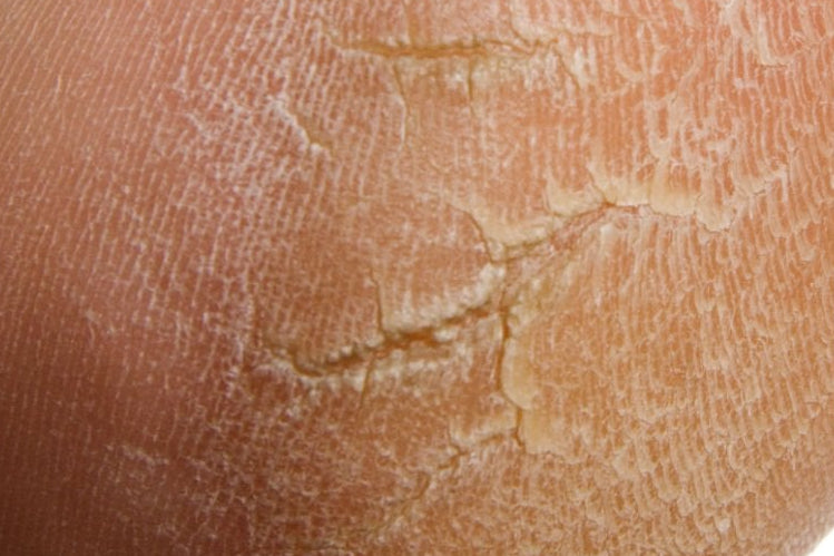 cracked heels