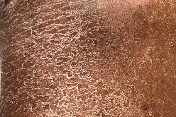 scaly skin