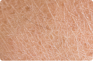 dry skin