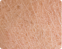 dry skin