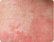 irritated skin