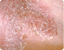 rough skin