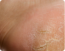 cracked heels