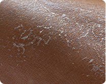 flaky skin