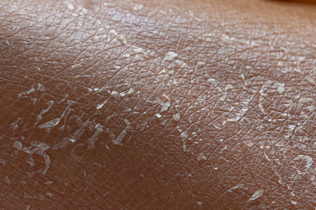 flaky skin