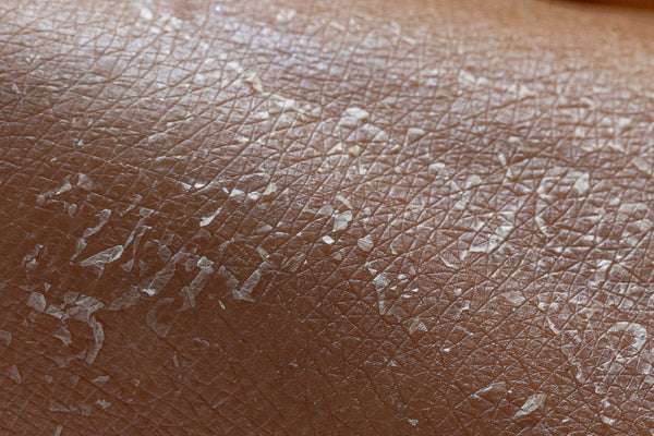 flaky skin