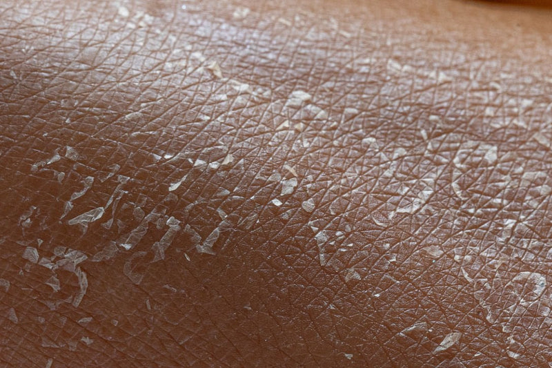 flaky skin