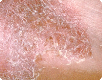 rough skin